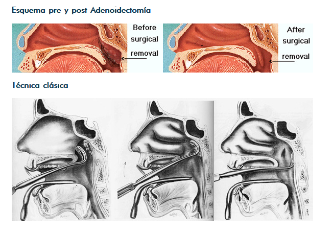 Adenoidectomía