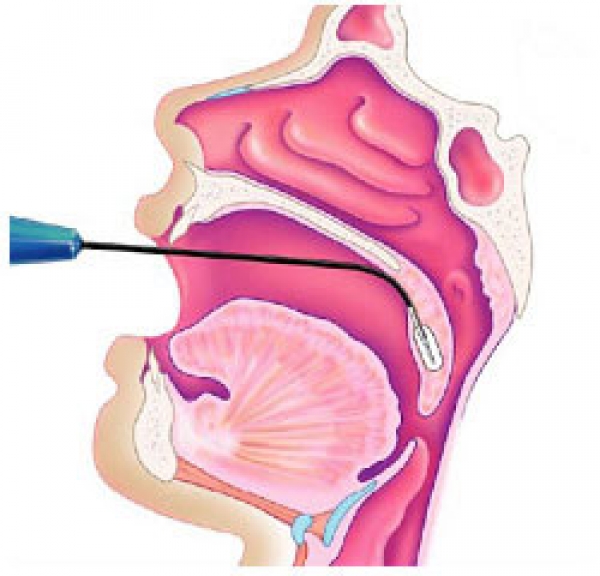 Uvulopalatoplastia (reducción o resección)